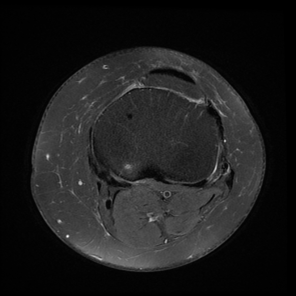File:Anterior cruciate ligament tear, Wrisberg rip and bucket-handle tear of medial meniscus (Radiopaedia 75872-87266 Axial PD fat sat 7).jpg