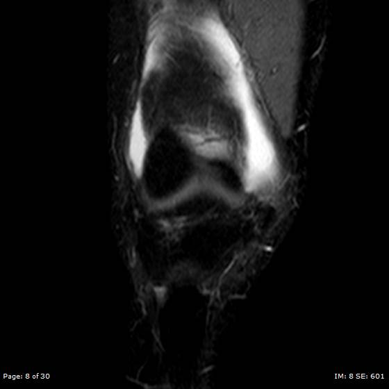 File:Anterior cruciate ligament tear (Radiopaedia 70783-80964 Coronal STIR 8).jpg