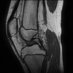 Anterior cruciate ligament tear - pediatric (Radiopaedia 62152-70260 Sagittal PD 84).jpg