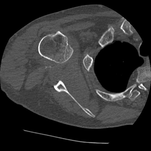 File:Anterior glenohumeral dislocation with Hill-Sachs lesion (Radiopaedia 62877-71249 Axial bone window 48).jpg