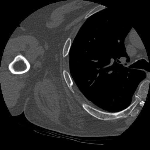 File:Anterior glenohumeral dislocation with Hill-Sachs lesion (Radiopaedia 62877-71249 Axial bone window 80).jpg