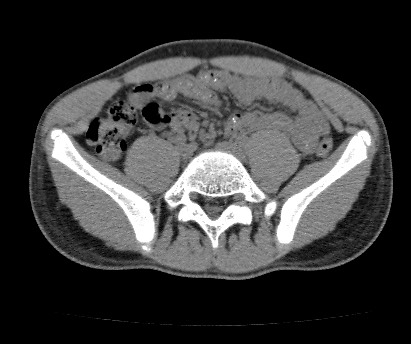 Anterior inferior iliac spine avulsion fracture (Radiopaedia 81312-94999 Axial non-contrast 20).jpg