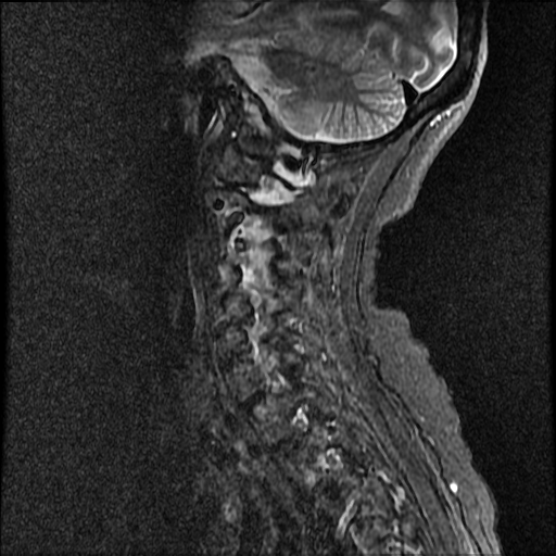 File:Anterior spinal artery syndrome (Radiopaedia 46335-50750 Sagittal STIR 9).png
