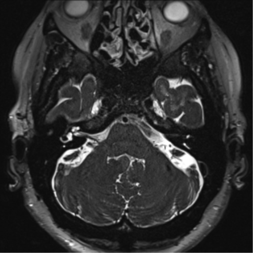 Anterior temporal pole cysts (Radiopaedia 46629-51102 Axial 2).png
