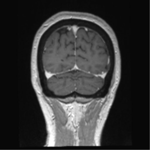 Anterior temporal pole cysts (Radiopaedia 46629-51102 Coronal T1 C+ 31).png