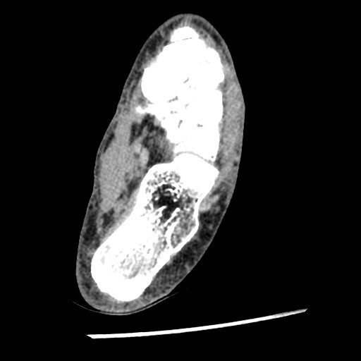 Anterior tibial artery false aneurysm (Radiopaedia 88984-105809 A 187).jpg