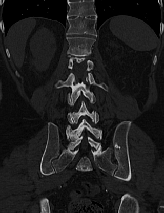 Anterior vertebral scalloping (abdominal aortic aneurysm) (Radiopaedia 66744-76067 Coronal bone window 52).jpg