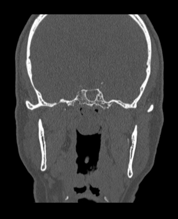 Antrochoanal polyp (Radiopaedia 79011-92169 Coronal bone window 12).jpg