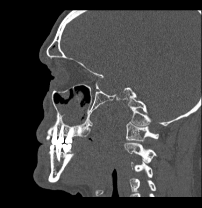 Antrochoanal polyp (Radiopaedia 79011-92169 Sagittal bone window 10).jpg