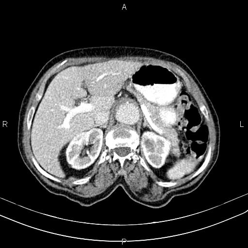 File:Aortic aneurysm and Lemmel syndrome (Radiopaedia 86499-102554 A 25).jpg