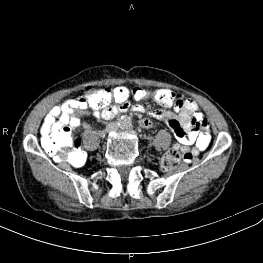 Aortic aneurysm and Lemmel syndrome (Radiopaedia 86499-102554 Axial C+ delayed 51).jpg