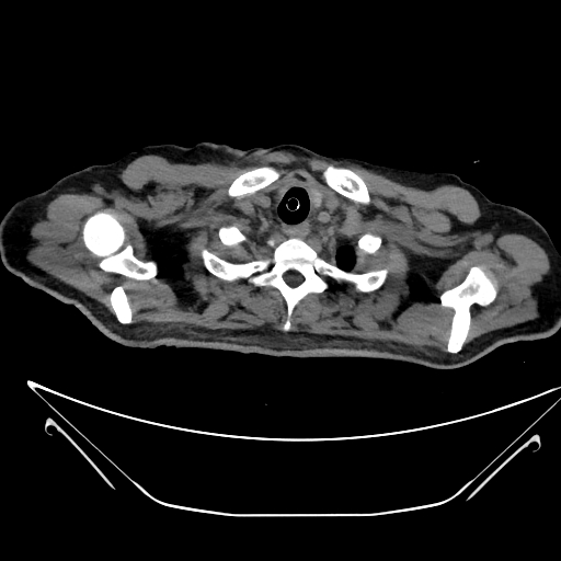 Aortic arch aneurysm (Radiopaedia 84109-99365 Axial non-contrast 28).jpg