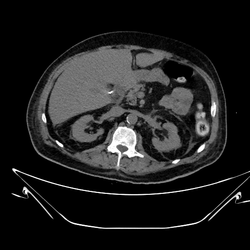 File:Aortic arch aneurysm (Radiopaedia 84109-99365 Axial non-contrast 315).jpg