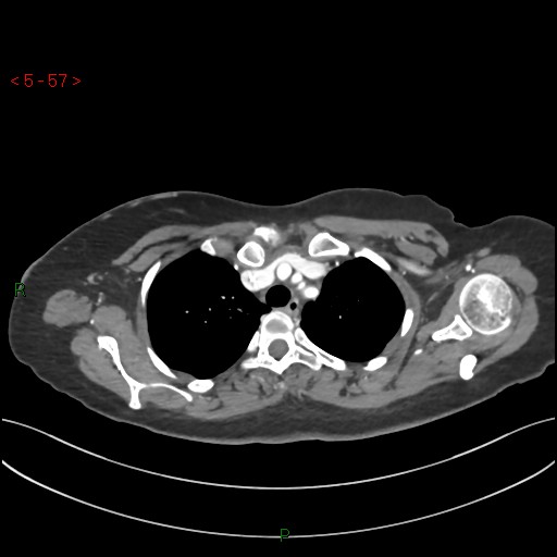 Aortic arch origin of left vertebral artery (Radiopaedia 51520-57286 A 56).jpg