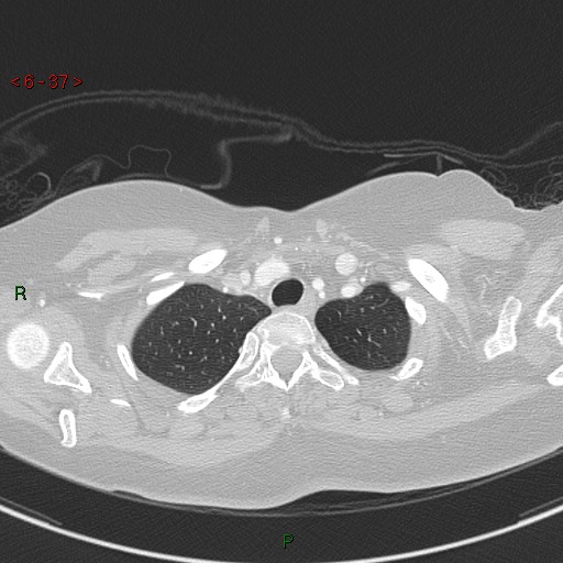 File:Aortic arch origin of left vertebral artery (Radiopaedia 51520-57286 Axial lung window 37).jpg