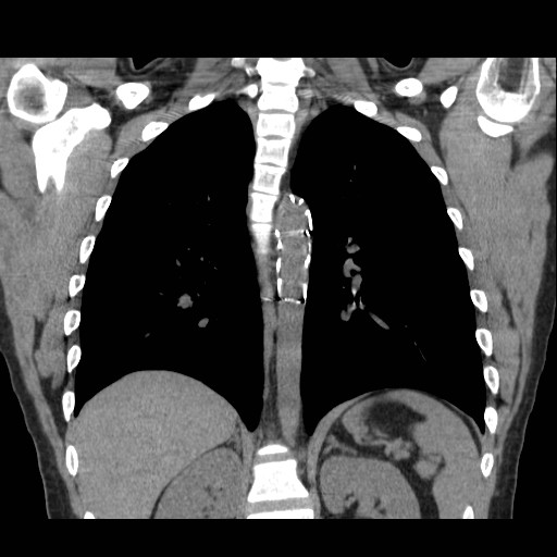 File:Aortic arch stent (Radiopaedia 30030-30595 Coronal non-contrast 20).jpg