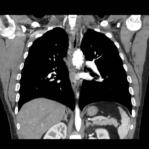 File:Aortic arch stent (Radiopaedia 30030-30595 F 19).jpg