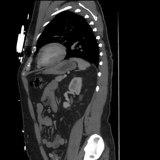File:Aortic dissection- Stanford A (Radiopaedia 37759-39664 Sagittal C+ delayed 34).png