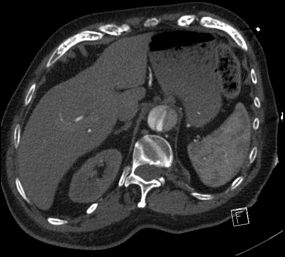 Aortic dissection (CTPA) (Radiopaedia 75506-86750 A 88).jpg