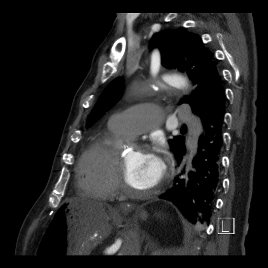 Aortic dissection (CTPA) (Radiopaedia 75506-86750 C 68).jpg