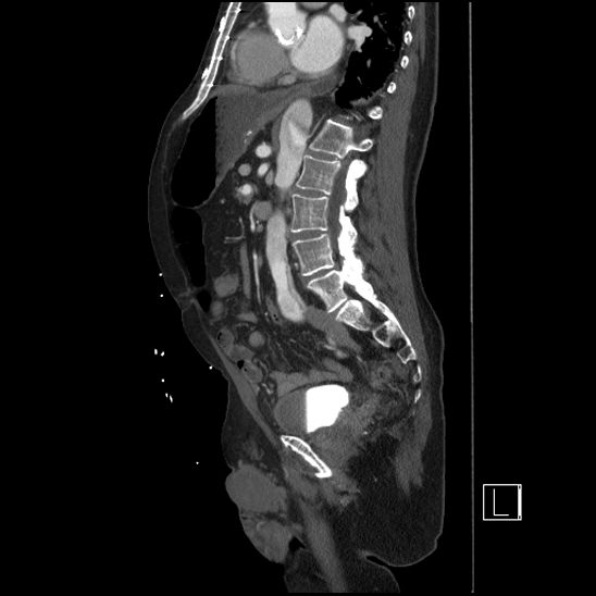 Aortic dissection (CTPA) (Radiopaedia 75506-86750 G 62).jpg