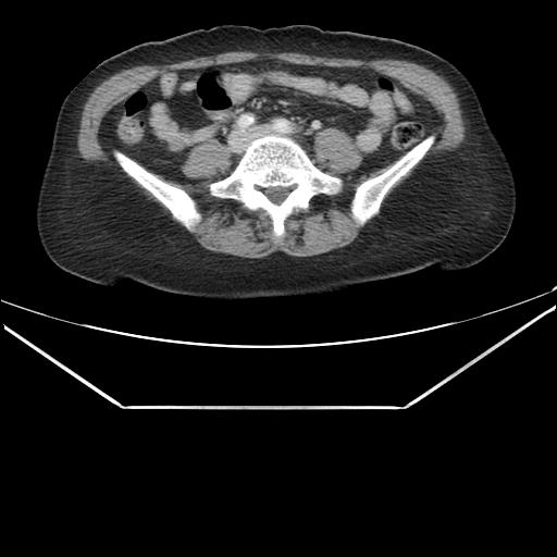 Aortic dissection (Radiopaedia 25350-25604 C 75).jpg