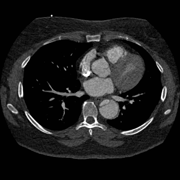 File:Aortic dissection (Radiopaedia 57969-64959 A 177).jpg