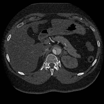 Aortic dissection (Radiopaedia 57969-64959 A 332).jpg