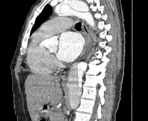 File:Aortic dissection - Stanford A -DeBakey I (Radiopaedia 28339-28587 C 36).jpg