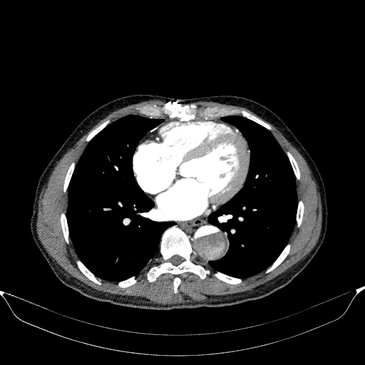File:Aortic dissection - Stanford type A (Radiopaedia 83418-98500 A 40).jpg