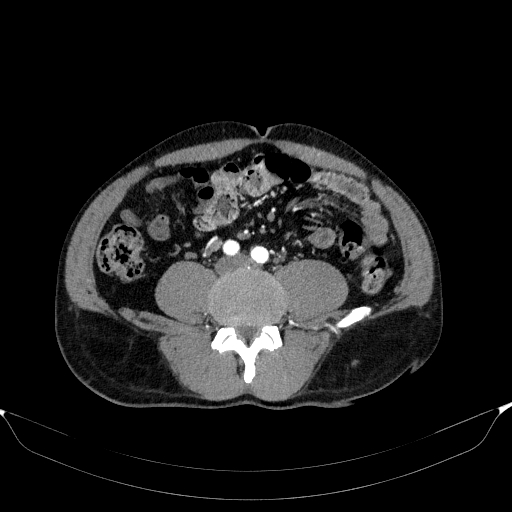 Aortic dissection - Stanford type A (Radiopaedia 83418-98500 A 91).jpg