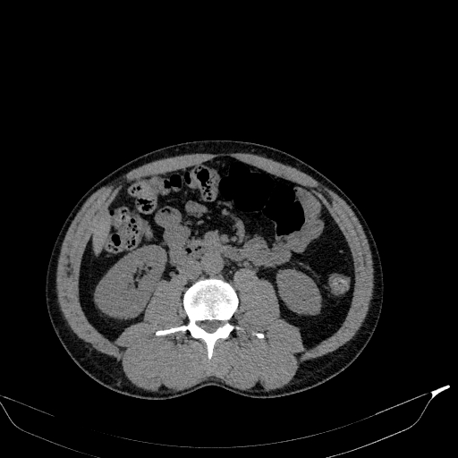 File:Aortic dissection - Stanford type A (Radiopaedia 83418-98500 Axial non-contrast 58).jpg