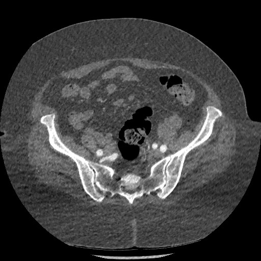 Aortic dissection - Stanford type B (Radiopaedia 88281-104910 A 143).jpg