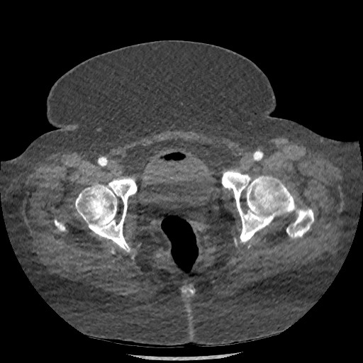 Aortic dissection - Stanford type B (Radiopaedia 88281-104910 A 158).jpg