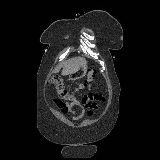 File:Aortic dissection - Stanford type B (Radiopaedia 88281-104910 B 6).jpg
