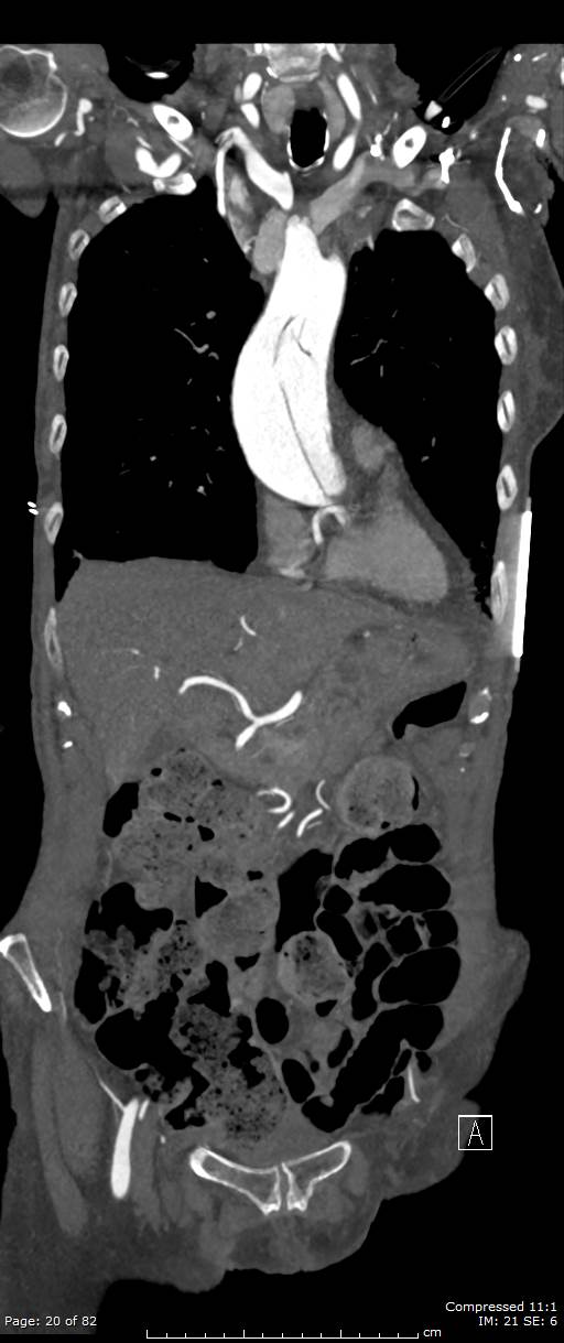 Aortic dissection with extension into aortic arch branches (Radiopaedia 64402-73204 A 20).jpg