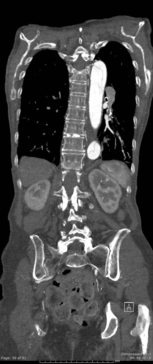 Aortic dissection with extension into aortic arch branches (Radiopaedia 64402-73204 A 58).jpg