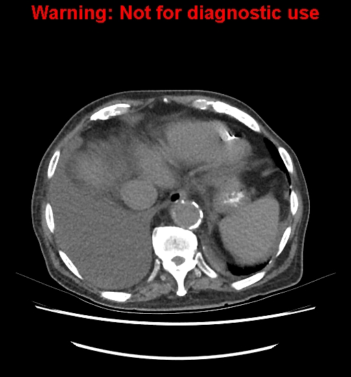 Aortic graft infection (Radiopaedia 44979-48907 Axial non-contrast 19).jpg