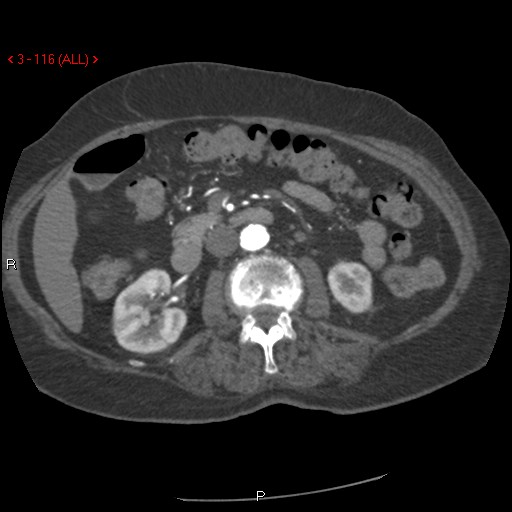 File:Aortic intramural hematoma (Radiopaedia 27746-28001 A 116).jpg