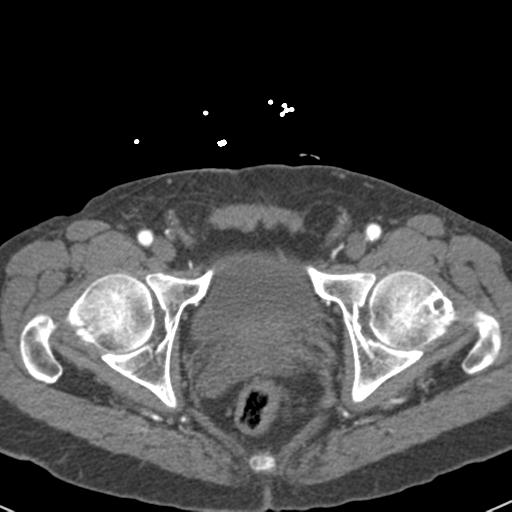 Aortic intramural hematoma (Radiopaedia 31139-31838 B 165).jpg