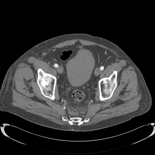 Aortic intramural hematoma (Radiopaedia 34260-35540 B 86).png