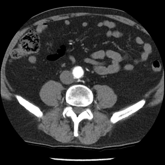Aortic intramural hematoma (type B) (Radiopaedia 79323-92387 B 83).jpg