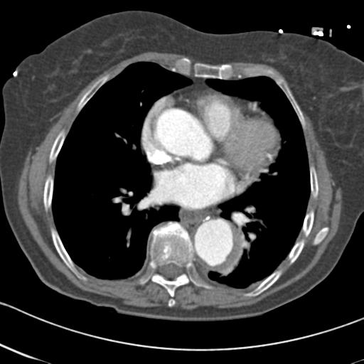 Aortic intramural hematoma from penetrating atherosclerotic ulcer (Radiopaedia 31137-31836 A 48).jpg