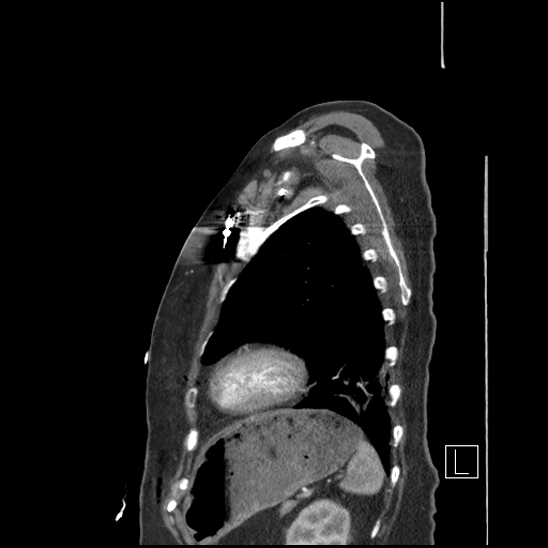 File:Aortic intramural hematoma with dissection and intramural blood pool (Radiopaedia 77373-89491 D 71).jpg