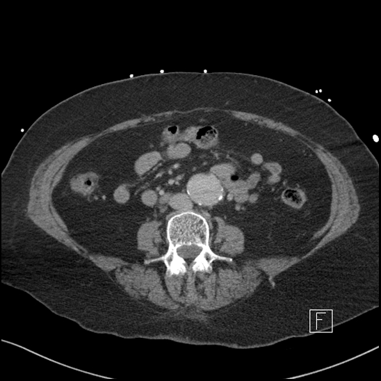 Aortic intramural hematoma with dissection and intramural blood pool (Radiopaedia 77373-89491 E 46).jpg