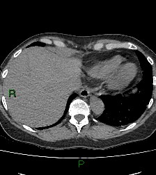 Aortic valve endocarditis (Radiopaedia 87209-103485 Axial non-contrast 82).jpg