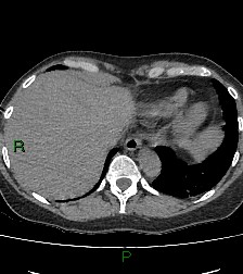 Aortic valve endocarditis (Radiopaedia 87209-103485 Axial non-contrast 83).jpg