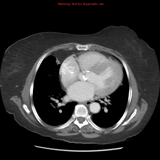 File:Aortic valve stenosis (Radiopaedia 14480-14423 C 11).jpg