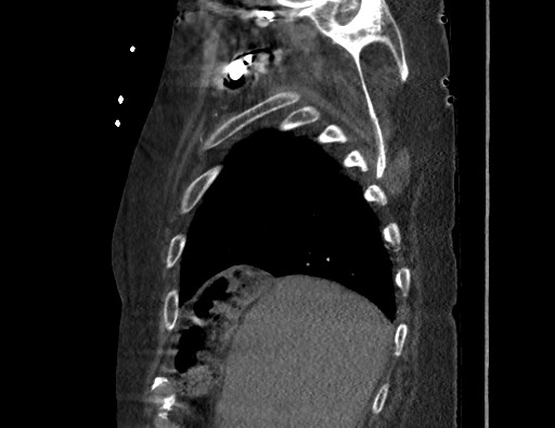 Aortoesophageal fistula with endovascular repair (Radiopaedia 73781-84592 Sagittal C+ CTPA 25).jpg