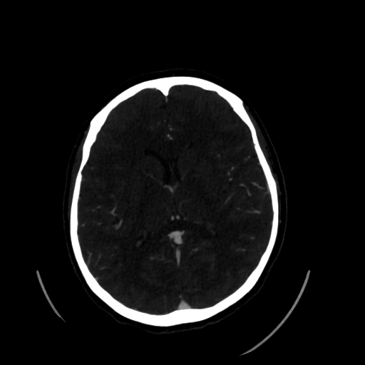 File:Aplasia of the internal carotid artery (Radiopaedia 61082-68960 A 39).jpg
